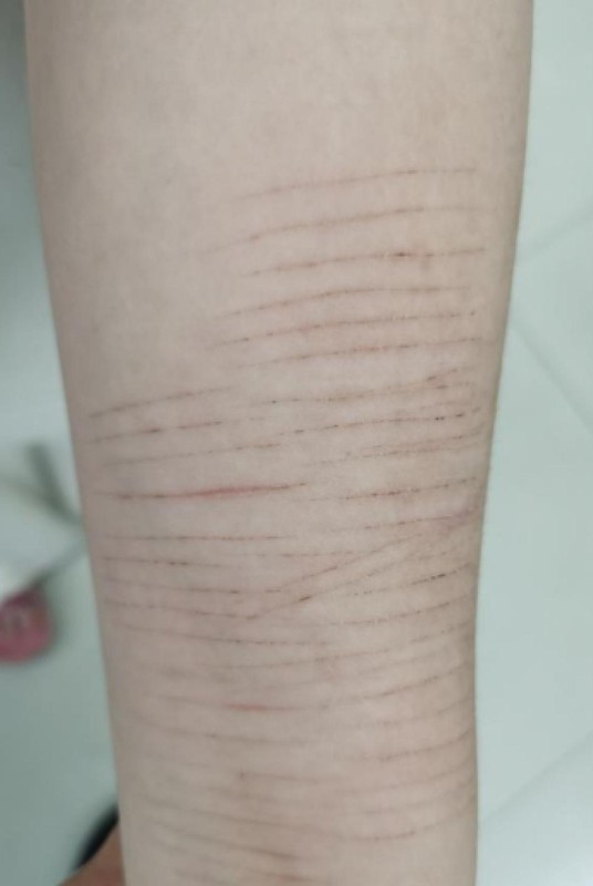  青少年非自杀性自伤行为的识别与干预：精神科医生的临床观察与系统方法论 健康养生